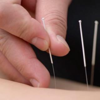 Pain Relief By Pin Pointing and Stimulating with Chiropractor and Acupuncturist Dr. Nguyen Lam